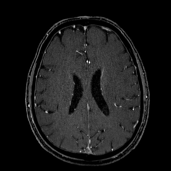 File:Accessory middle cerebral artery (Radiopaedia 73114-83828 Axial MRA 137).jpg