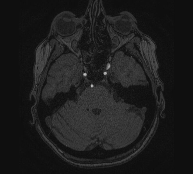 File:Accessory middle cerebral artery and ICA aneurysm (Radiopaedia 22656-22674 MRA 18).jpg
