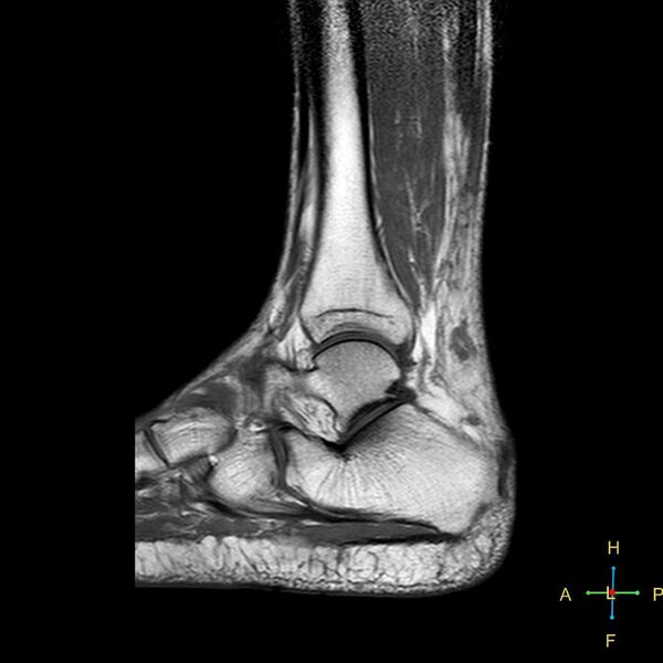 File:Achilles tendon complete tear (Radiopaedia 22834-22854 Sagittal T1 6).jpg