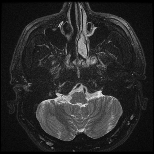 File:Acoustic schwannoma - intracanalicular (Radiopaedia 37247-39024 Axial T2 fat sat 4).jpg