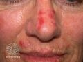 Actinic Keratoses treated with imiquimod (DermNet NZ lesions-ak-imiquimod-3739).jpg