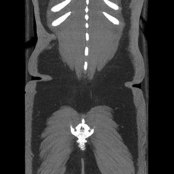 File:Active colonic bleed on CT (Radiopaedia 49765-55025 Coronal art MIP 57).jpg