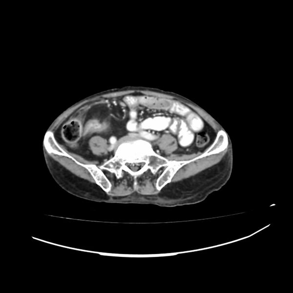 File:Acute-on-chronic Crohn disease with enteroenteric fistula (Radiopaedia 66686-75987 B 34).jpg