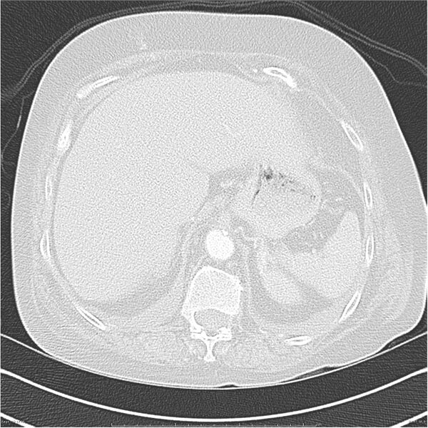 File:Acute-on-chronic pulmonary emboli (Radiopaedia 27925-28169 lung window 47).jpg