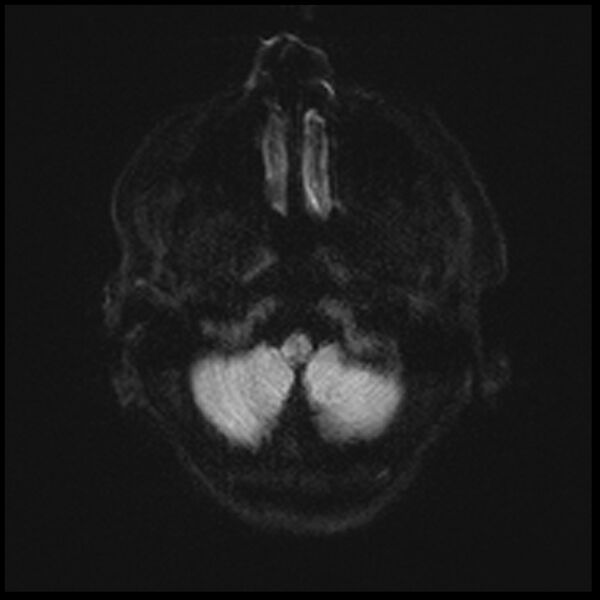 File:Acute P1 occlusion with PCA ischemia penumbra (CT perfusion) (Radiopaedia 72084-82590 Axial DWI 3).jpg