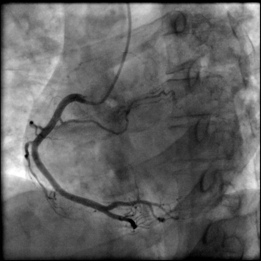Acute anteroseptal myocardial infarction (Radiopaedia 68409-77946 RAO straight RCA 32).jpg