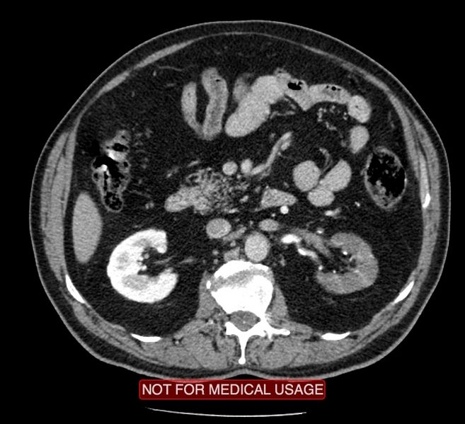 File:Acute aortic dissection - Stanford type A (Radiopaedia 40661-43285 Axial C+ portal venous phase 101).jpg