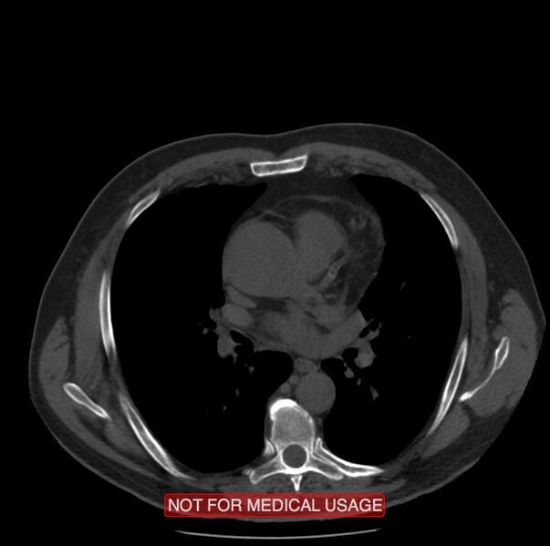 File:Acute aortic dissection - Stanford type A (Radiopaedia 40661-43285 Axial non-contrast 29).jpg