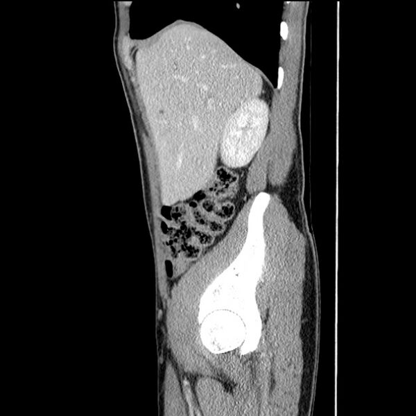 File:Acute appendicitis (Radiopaedia 27049-27227 Sagittal C+ portal venous phase 18).jpg