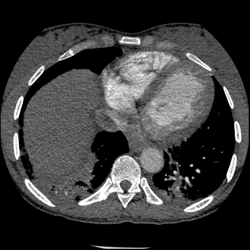 Acute chest syndrome - sickle cell disease (Radiopaedia 42375-45499 Axial C+ CTPA 142).jpg