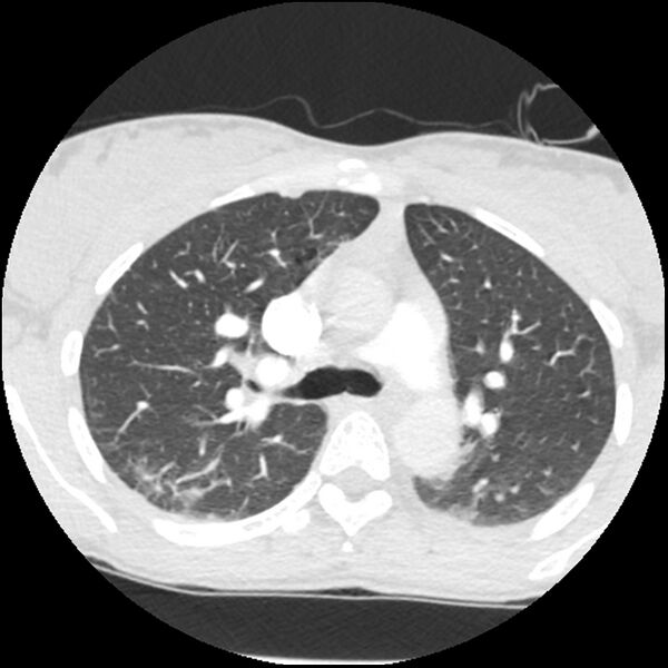 File:Acute chest syndrome - sickle cell disease (Radiopaedia 42375-45499 Axial lung window 69).jpg