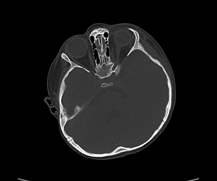 File:Acute hemorrhagic contusion (Radiopaedia 63660-72336 Axial bone window 22).jpg