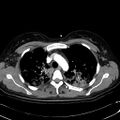 Acute myocardial infarction in CT (Radiopaedia 39947-42415 Axial C+ arterial phase 36).jpg