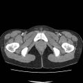 Acute myocarditis (Radiopaedia 55988-62613 Axial C+ portal venous phase 84).jpg