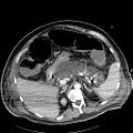 Acute pancreatic necrosis (Radiopaedia 13560-18502 Axial C+ portal venous phase 19).jpg