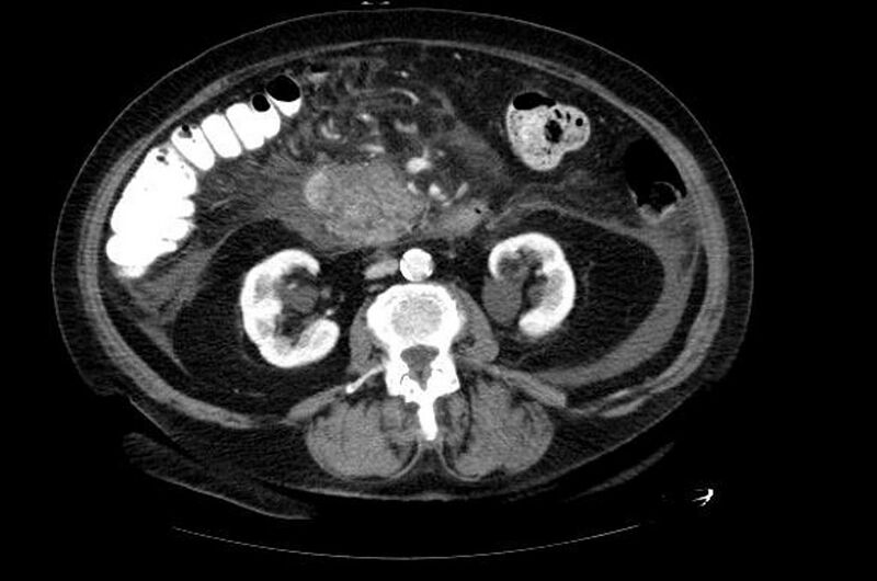 File:Acute pancreatitis (Radiopaedia 11163-11528 Axial 5).jpg
