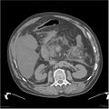 Acute pancreatitis (Radiopaedia 19135-19116 Axial non-contrast 18).jpg