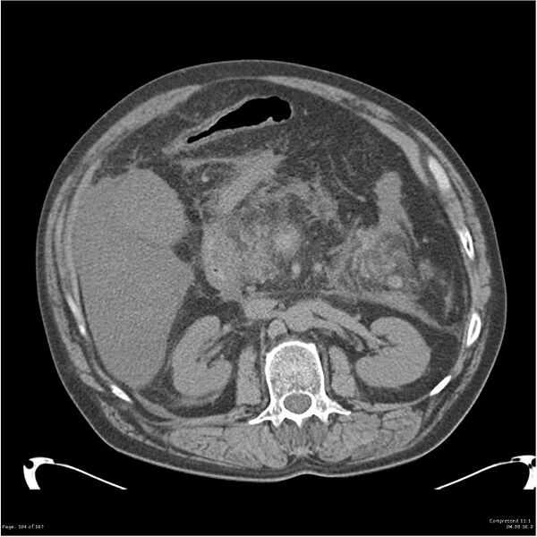 File:Acute pancreatitis (Radiopaedia 19135-19116 Axial non-contrast 18).jpg