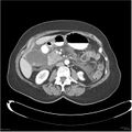 Acute pancreatitis (Radiopaedia 19136-19117 Axial C+ portal venous phase 18).jpg