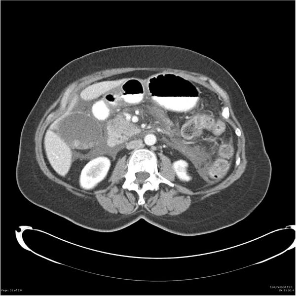 File:Acute pancreatitis (Radiopaedia 19136-19117 Axial C+ portal venous phase 18).jpg