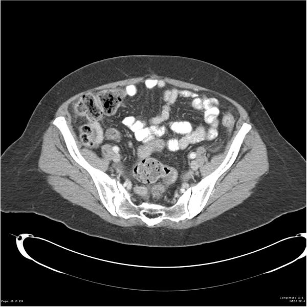File:Acute pancreatitis (Radiopaedia 19136-19117 Axial C+ portal venous phase 34).jpg