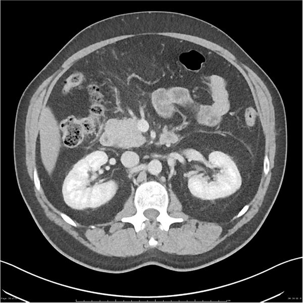 File:Acute pancreatitis - mild (Radiopaedia 27796-28033 C+ portal venous phase 17).jpg