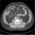 Acute pancreatitis - mild (Radiopaedia 27796-28033 C+ portal venous phase 32).jpg