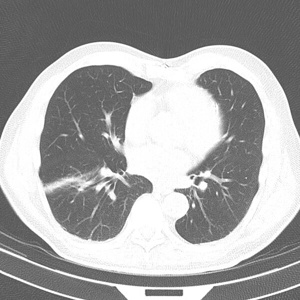 File:Acute pulmonary embolism (Radiopaedia 81677-95570 Axial lung window 27).jpg