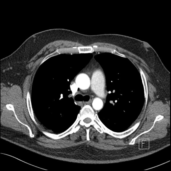 File:Acute pulmonary embolism with pulmonary infarct (Radiopaedia 73062-83768 Axial C+ CTPA 26).jpg