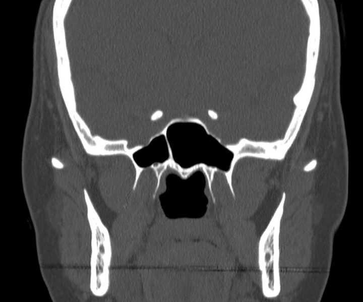 File:Acute sinusitis (Radiopaedia 22419-22455 Coronal bone window 31).jpg