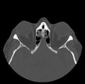 Acute sinusitis (Radiopaedia 23161-23215 Axial bone window 51).jpg