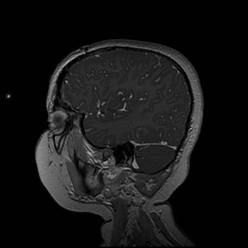 Adamantinomatous craniopharyngioma (Radiopaedia 77407-89529 H 94).jpg