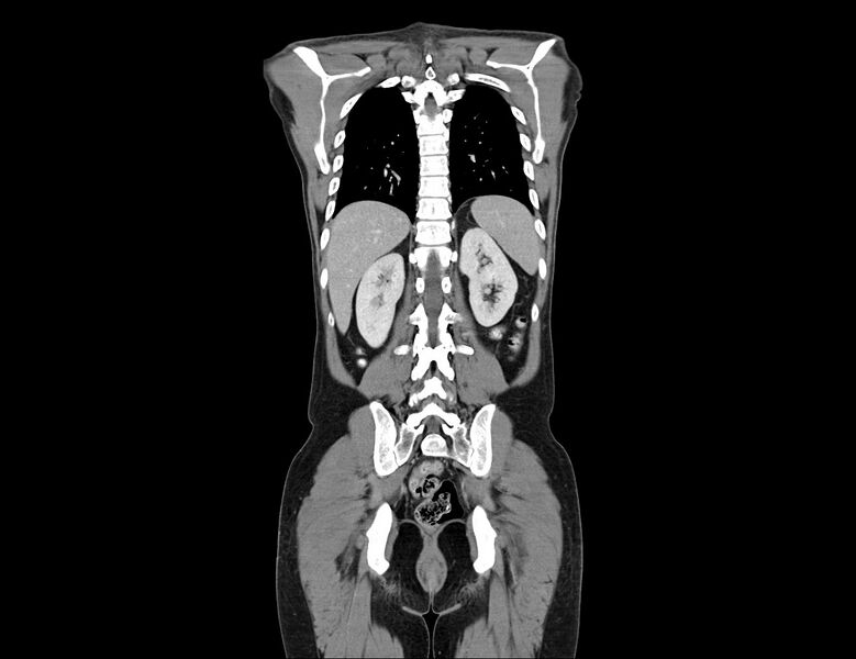File:Addison disease (Radiopaedia 49318-54412 Coronal C+ portal venous phase 10).jpg