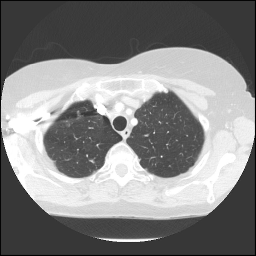 Adenocarcinoma of the lung (Radiopaedia 41015-43755 Axial lung window 21).jpg