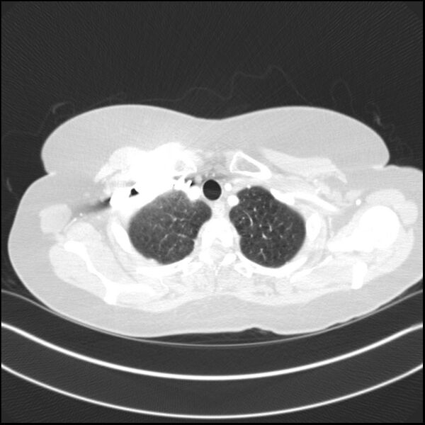 File:Adenocarcinoma of the lung (Radiopaedia 44205-47803 Axial lung window 16).jpg