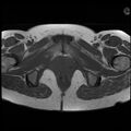 Adenoma malignum of the cervix (Radiopaedia 24460-24765 T1 18).jpg