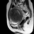 Adenomyoma of the uterus (huge) (Radiopaedia 9870-10438 Sagittal T2 14).jpg
