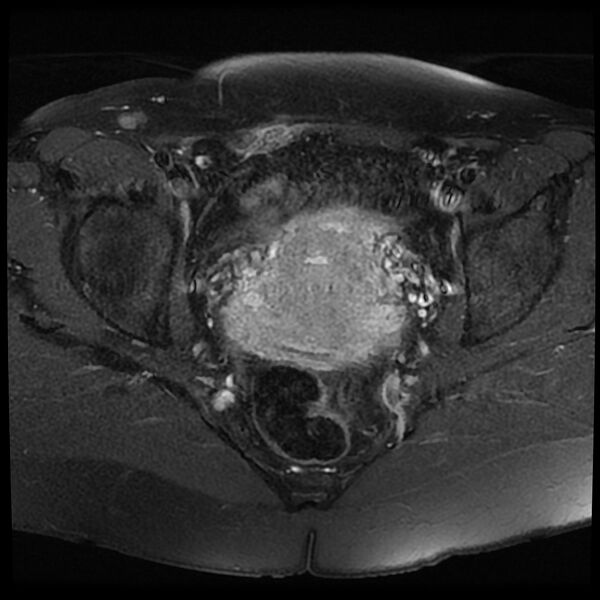 File:Adenomyosis-scar endometriosis (Radiopaedia 65863-75022 Axial T1 C+ fat sat 15).jpg