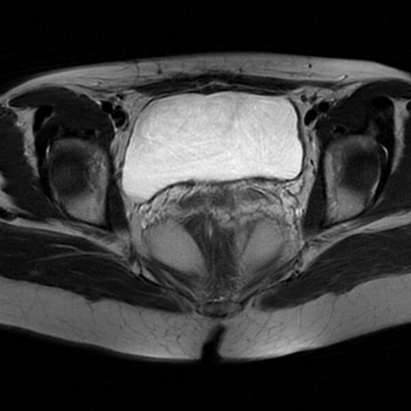 File:Adenomyosis within a septate uterus (Radiopaedia 69963-79981 Axial T2 23).jpg