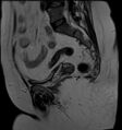 Adnexal multilocular cyst (O-RADS US 3- O-RADS MRI 3) (Radiopaedia 87426-103754 Sagittal T2 9).jpg