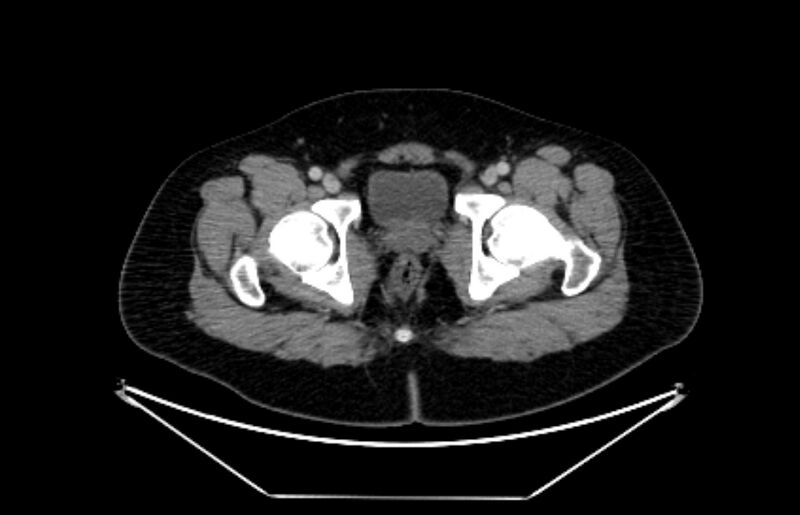 File:Adrenocortical carcinoma (Radiopaedia 80134-93438 Axial C+ portal venous phase 128).jpg