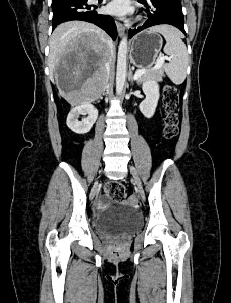 File:Adrenocortical carcinoma (Radiopaedia 87281-103569 Coronal C+ portal venous phase 66).jpg
