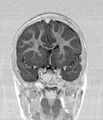 Aicardi syndrome (Radiopaedia 66029-75205 Coronal T1-IR 9).jpg