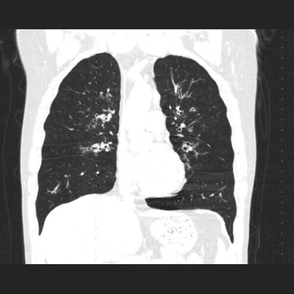 File:Allergic bronchopulmonary aspergillosis (Radiopaedia 21386-21320 Coronal lung window 7).jpg