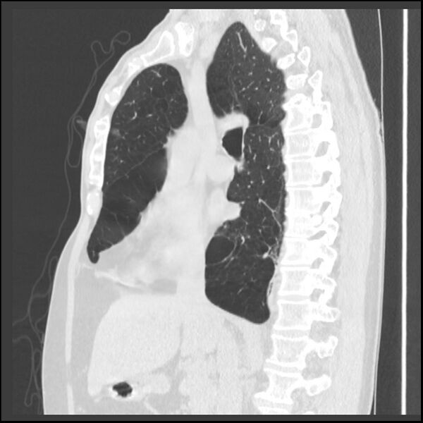 File:Alpha-1-antitrypsin deficiency (Radiopaedia 40993-43722 Sagittal lung window 149).jpg