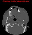 Ameloblastoma (Radiopaedia 13276-13280 Axial non-contrast 16).jpg