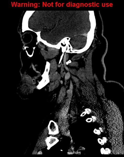 File:Ameloblastoma (Radiopaedia 33126-34164 F 50).jpg