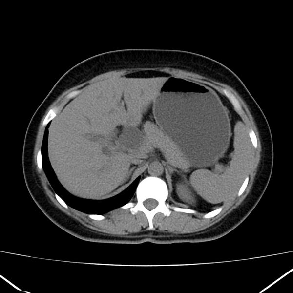 File:Ampullary tumor (Radiopaedia 22787-22816 Axial non-contrast 15).jpg