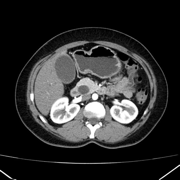 File:Ampullary tumor (Radiopaedia 22787-22816 B 37).jpg