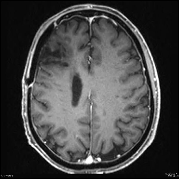 File:Anaplastic meningioma with recurrence (Radiopaedia 34452-35788 Axial T1 C+ 99).jpg